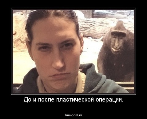 До и после пластической операции.