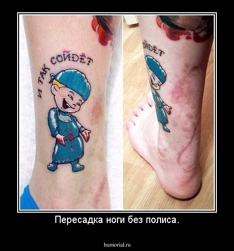 Пересадка ноги без полиса.